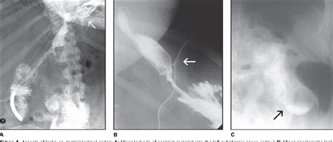 Anastomotic Leak After Gastric Bypass Surgery